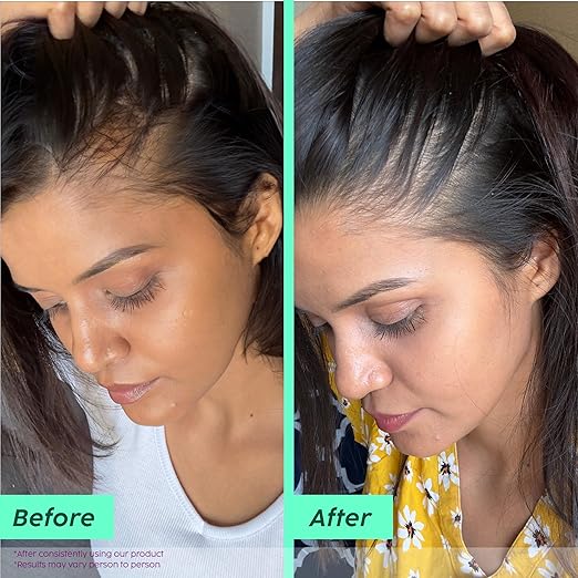 PLIX – The Plant Fix Rosemary Advanced Anti-Hair Fall Shampoo | Reduces Hair Fall & Breakage | Sulphate & Paraben Free | For Men & Women | 200ml PLIX