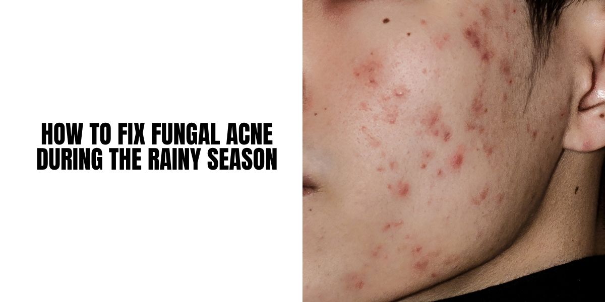 How to Fix Fungal Acne During the Rainy Season