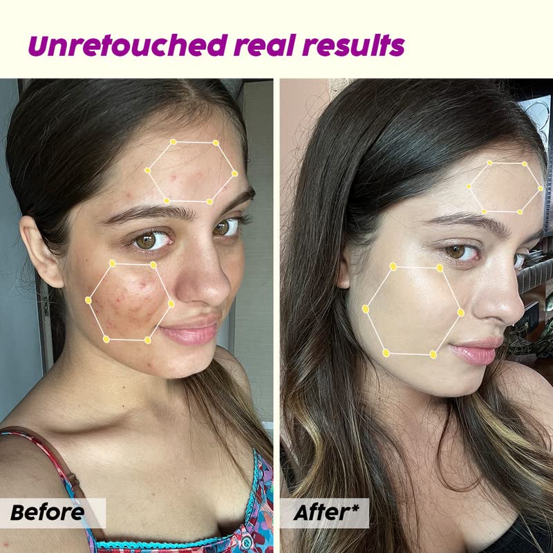 PLIX – The Plant Fix 10% Niacinamide Jamun Face Serum | 1% Zinc & Witch Hazel | Controls Oil, Reduces Acne Marks & Blemishes | For Acne-Prone Skin | 30ml PLIX