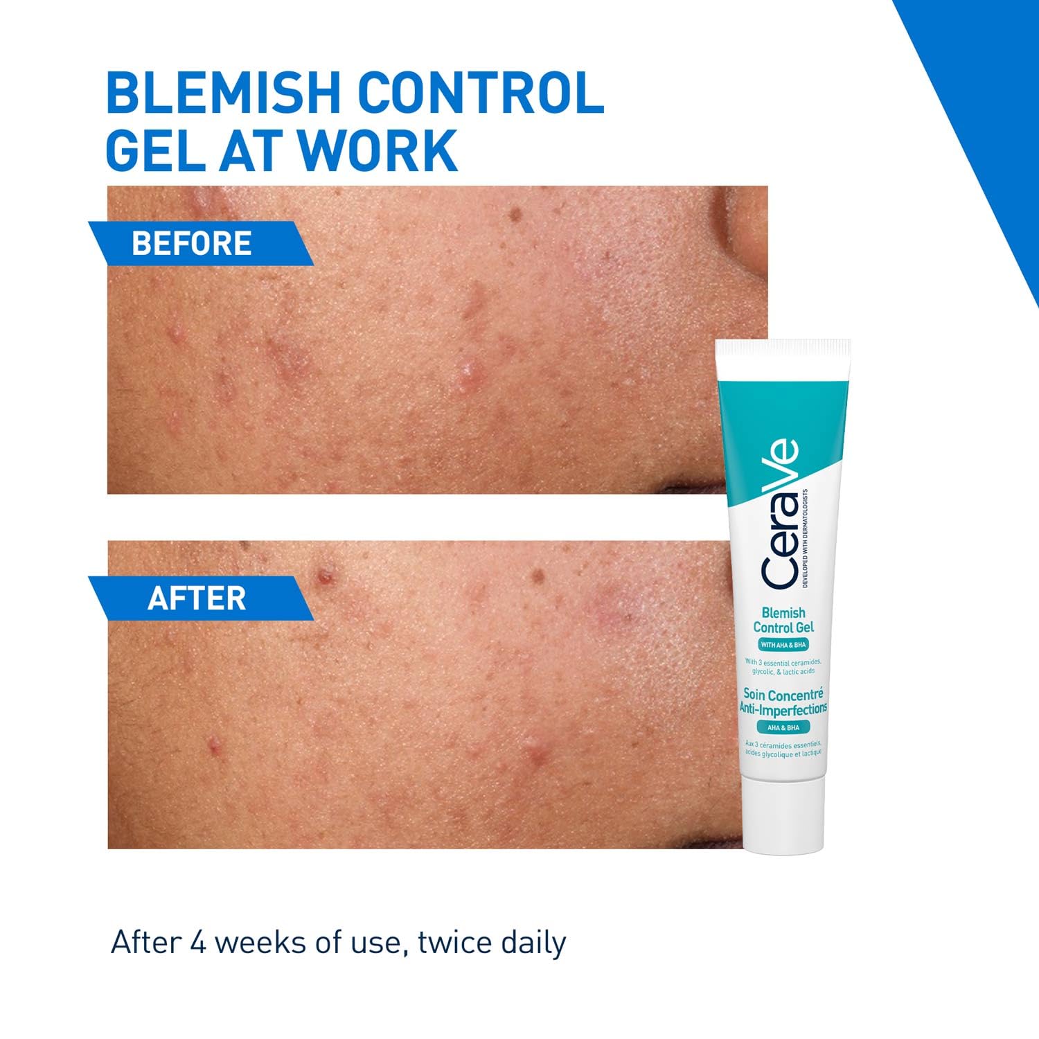 CeraVe Blemish Control Gel with 2% Salicylic Acid, AHA & Niacinamide for Acne Spot Treatment (40ml) CeraVe