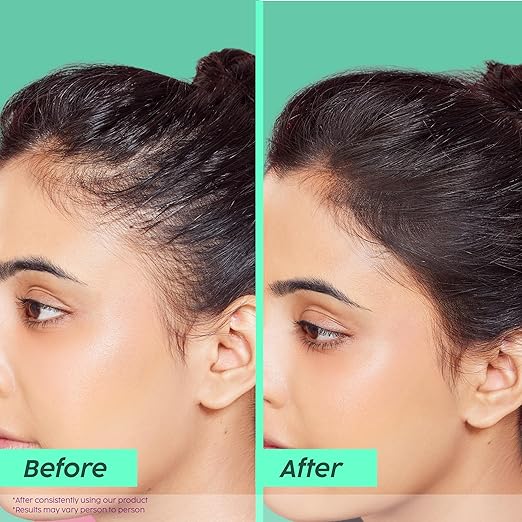 PLIX – The Plant Fix Rosemary Advanced Anti-Hair Fall Shampoo | Reduces Hair Fall & Breakage | Sulphate & Paraben Free | For Men & Women | 200ml PLIX